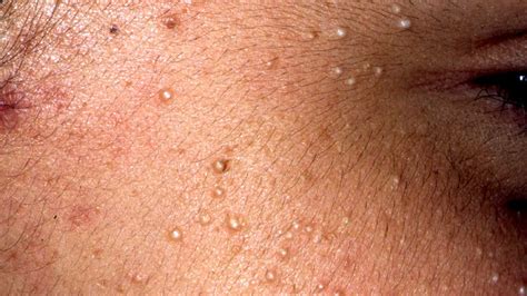White Spots On Lips Disease
