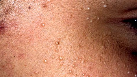 There has been answered by dr. Bumps on Lips: Causes, Treatments, and More