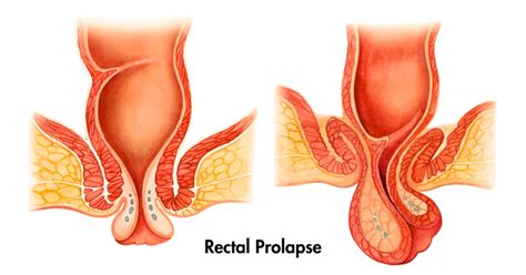 Rectal Prolapse Symptoms Causes And Treatment Dr Avadh Patel