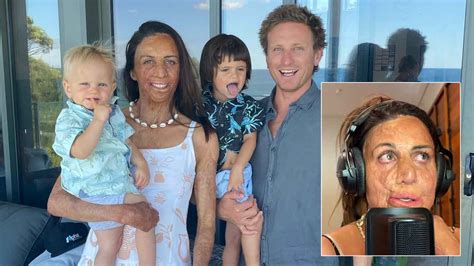 Turia Pitt Opens Up About Life Changing Surgery After Demoralising