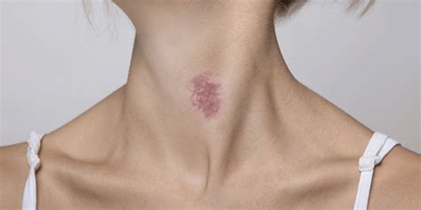 How To Get Rid Of A Hickey Quickly 27 Proven And Effective Ways