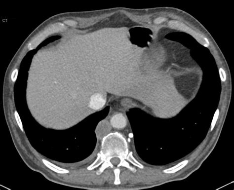 Lymphoma With Extensive Adenopathy And Encasement Of The Pulmonary