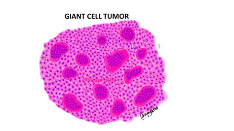 GIANT CELL TUMOR BONE Pathology Made Simple