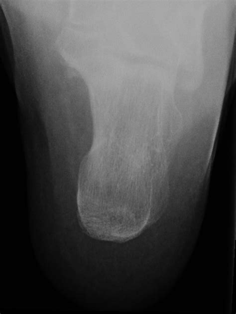 Interesting radiology cases from daily practice and a personal reference. Haglund deformity | Image | Radiopaedia.org