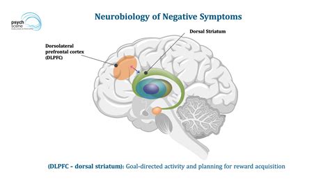 Negative Symptoms In Schizophrenia Diagnosis And Management