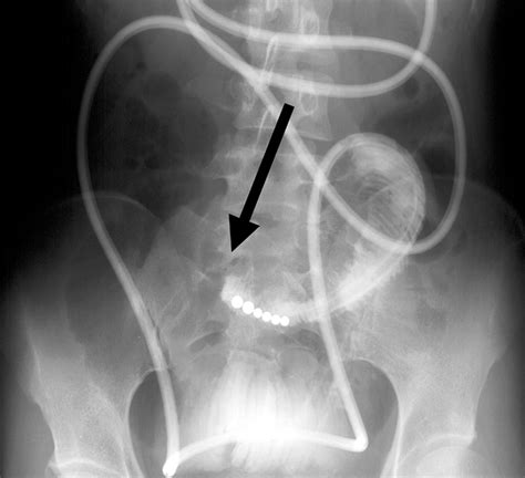 Ct Of Internal Hernias Radiographics