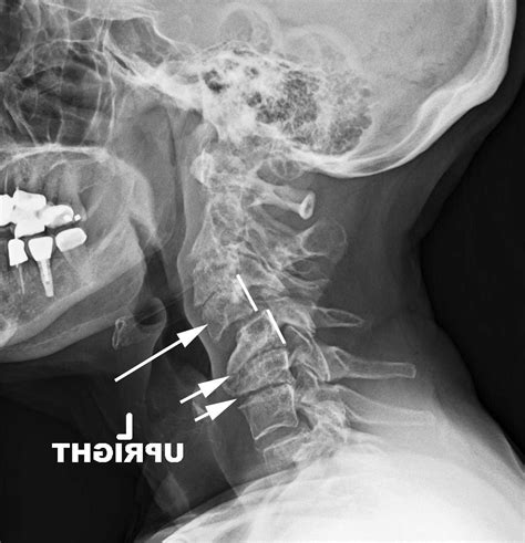 Symptoms Of Cervical Retrolisthesis Best Custom Academic Essay