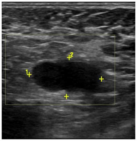 Axillary Lymph Nodes Ultrasound