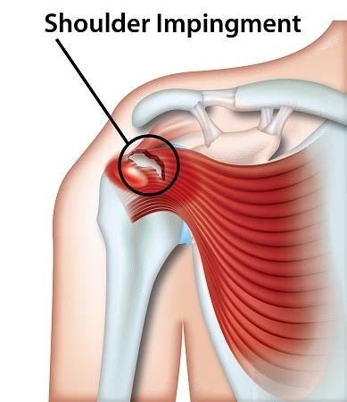 Posted by team nat on may 28, 2017. Shoulder Impingement (Swimmer's shoulder) - Information ...
