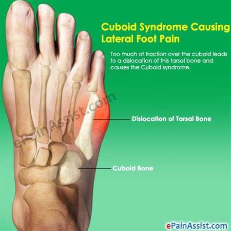 There are 3 very common regions for pain on the side of your foot. Learn All About Muscle Spasm Outside Of Foot From This ...