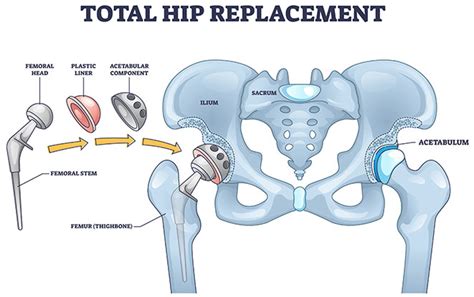 A New Minimally Invasive Hip Replacement Surgery Anterior Approach