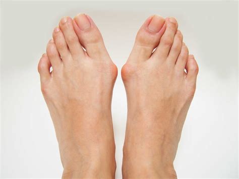 Bunions Causes Symptoms And Treatment Sanders Podiatry Clinics