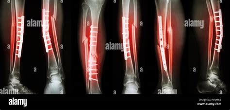 Tibial Fracture Fixation Hi Res Stock Photography And Images Alamy