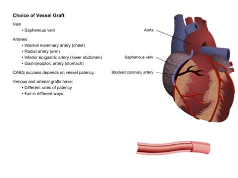 Cardiovascularcoronaryarterybypassgrafting