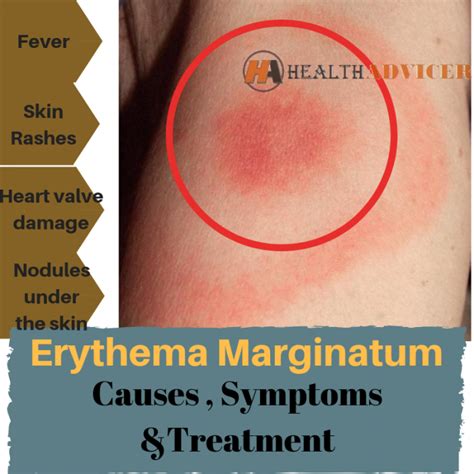 Erythema Marginatum Causes Picture Symptoms And Treatment