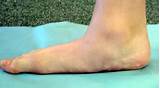 Pictures of Flat Feet