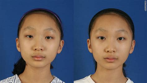 Plastic Surgery Boom As Asians Seek Western Look