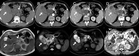 Malignant Lymphoma Diagnosed As Gallbladder Carcinoma On 18f