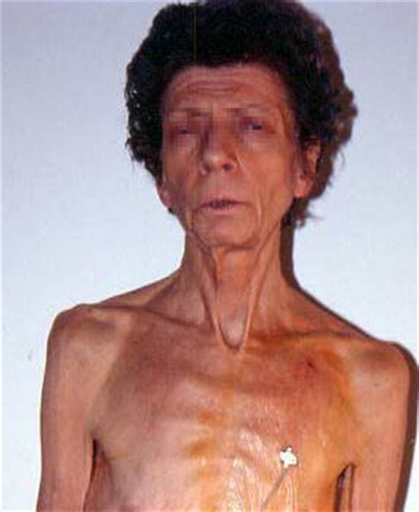 Acrodermatite enteropatica in corso di alimentazione parenterale in un neonato di basso peso. Alimentazione Parenterale Domiciliare