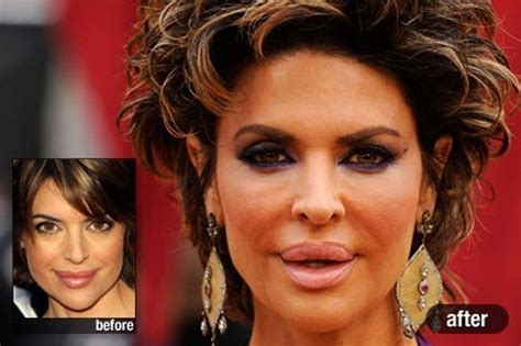 Lisa Rinna Before And After Lip Fillers Lipfillersbruising Bad