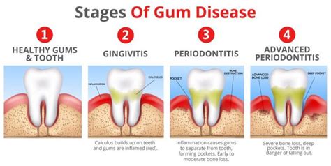 Bleeding Gum Dentist 3 Stages Of Periodontal Disease Know The Signs