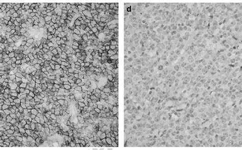 The Diffuse Large B Cell Lymphoma In Case 1 Co Expressed Cd3 With A