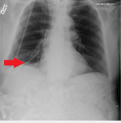 Chest X Ray Demonstrating The Dobhoff Tube Penetrating The Right Lung