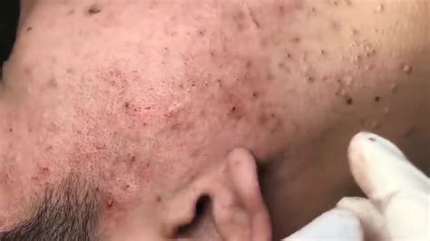 Blackheads Removal Acne How To Removal Cystic Acne Pimple Remove 2k18