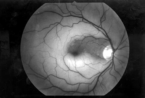 Acute Occlusion Of The Retinal Arteries Current Concepts And Recent