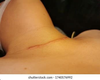 Thyroid Surgery Scar Images Stock Photos Vectors Shutterstock