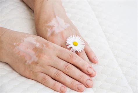 7 Home Remedies To Prevent And Reduce Vitiligo Emedihealth