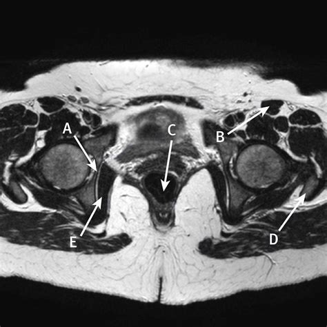 Axial T Weighted Magnetic Resonance Imaging Of The Female Pelvis The Bmj