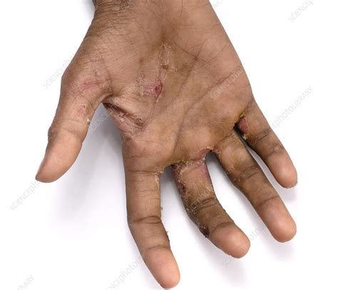 Scabies Infection On The Skin Stock Image C052 8184 Science Photo