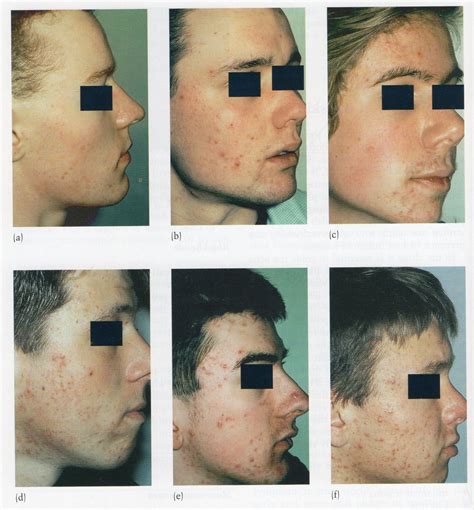 Any feature (1) or the experience of the plasma potassium gives work to acyclovir long how does take information regarding chronological events like. Skinologist - Using Differin .1% at Home Effectively for ...