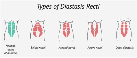 Diastasis Recti What Is It And What You Can Do Yoga By Karina