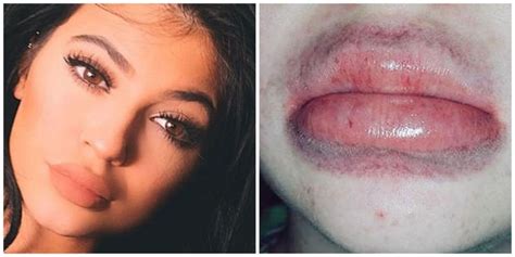 The Stupidest Trend Of The Moment Kylie Jenners Lip Challenge And Fuller Lips Everything Mixed