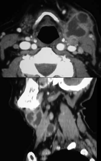 Computed Tomography Image Showing Left Cervical And Supraclavicular