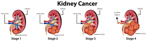 Kidney Renal Cell Cancer Stages Moffitt