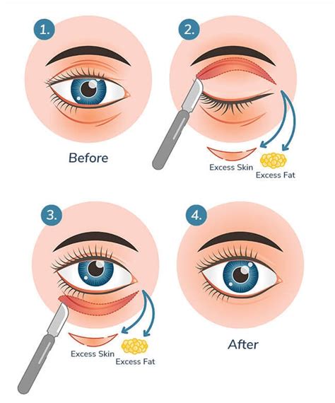 Blepharoplasty And Eyelid Surgery Houston Eye
