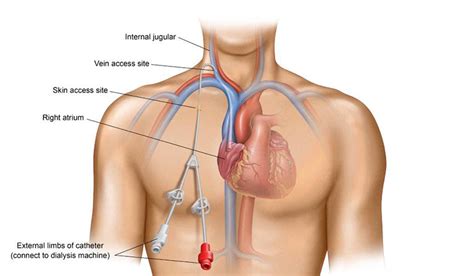중심정맥관 삽입술 Central venous catheter insertion 네이버 블로그