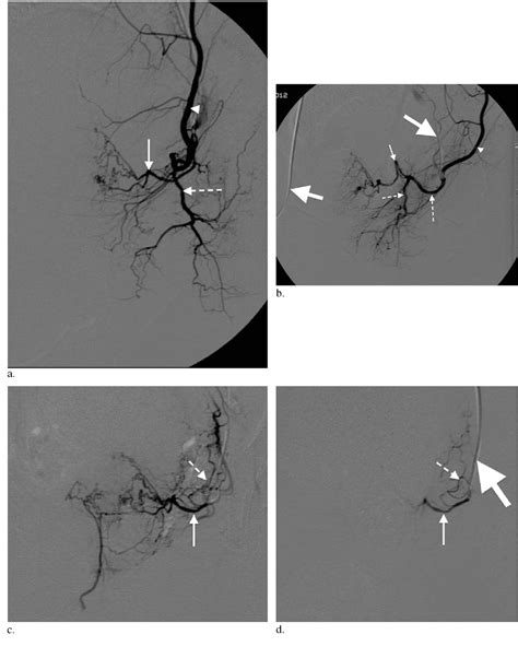 Figure 2 From The Role Of Accessory Obturator Arteries In Prostatic