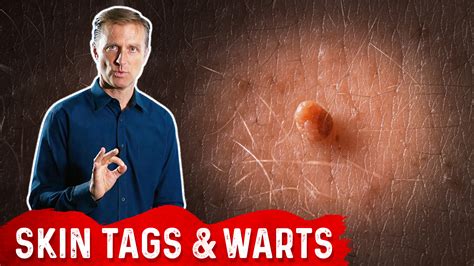 Unless you’re a child, you’ve probably heard cautionary tales from your doctor about the dangers of high cholesterol. Use Iodine for Skin Tags and Warts | Dr.Berg Blog