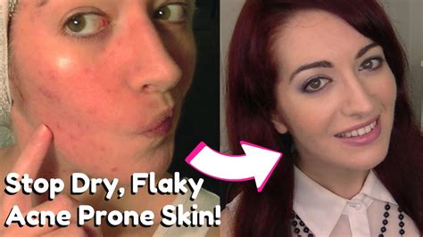 How To Stop And Remove Dry Flaky Skin Dry And Acne Prone Skin Care