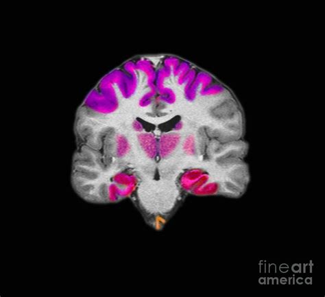 Brain Areas Affected By Alzheimers Photograph By Medical Body Scans