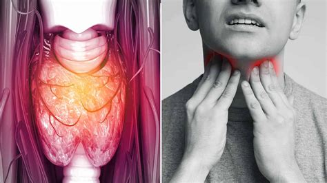 white spots on throat symptoms