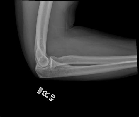 Radial Head Fracture Non Displaced Image