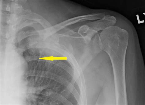 Pancoast Tumor Chest X Ray Wikidoc