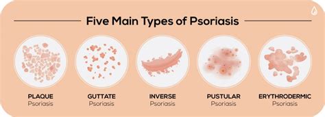 Different Types Of Psoriasis Treatments Healthcare And Medicine
