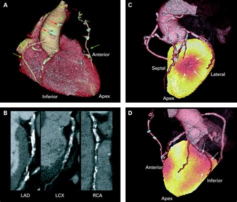 Cardiovascular Nuclear Imaging From Perfusion To Molecular Function