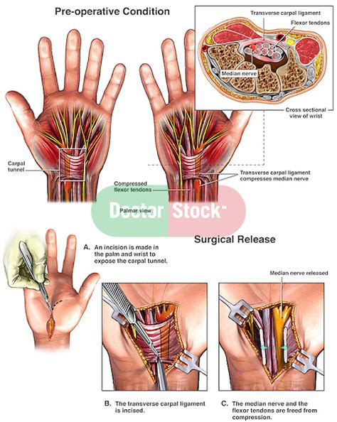 Bilateral Carpal Tunnel Syndrome With Surgical Release Doctor Stock